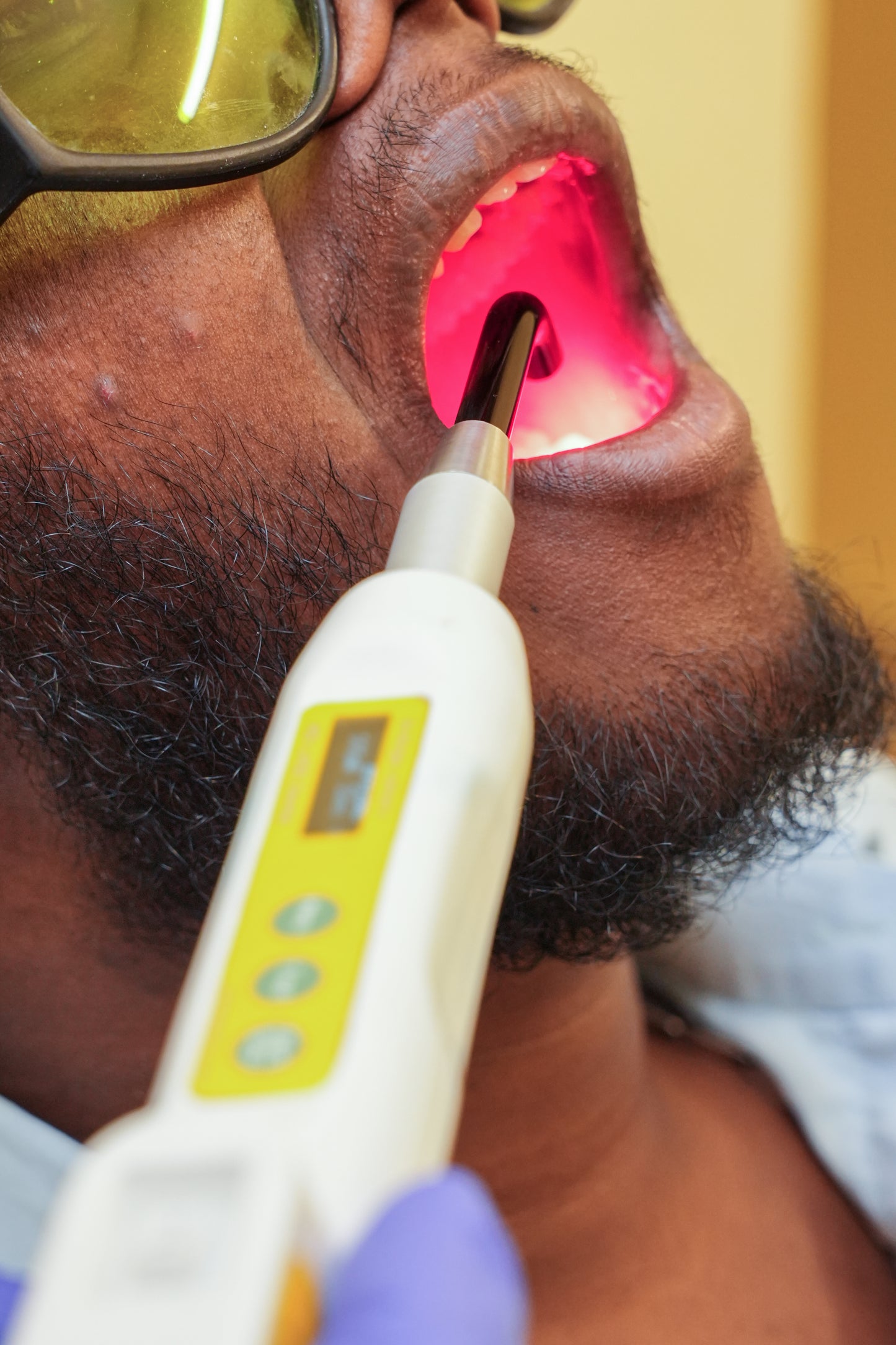 HD Lase Dental - Home Gum Care Kit